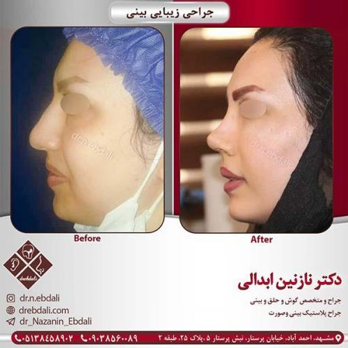 جراحی-بینی-مشهد-91