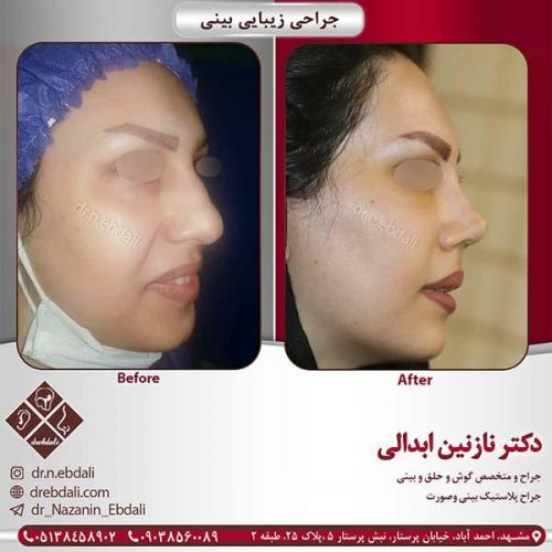 جراحی-بینی-مشهد-92