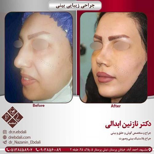 جراحی-بینی-مشهد-94
