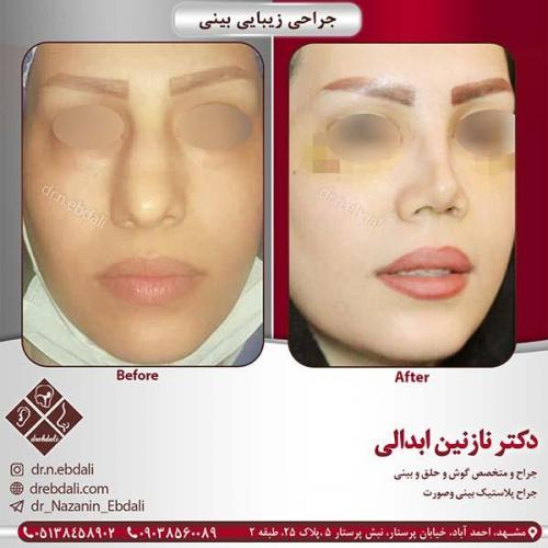 جراحی-بینی-مشهد-95
