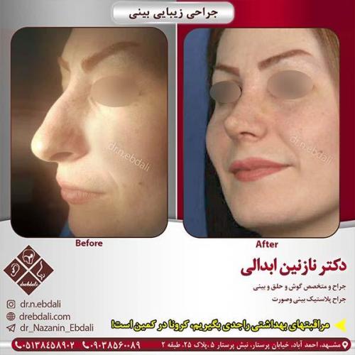 جراحی-بینی-مشهد-97