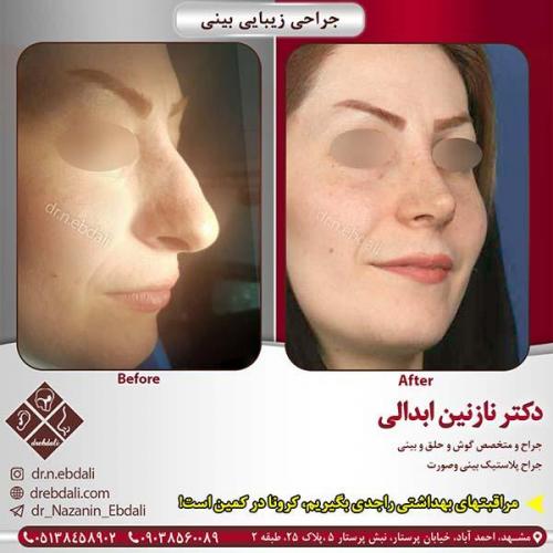 جراحی-بینی-مشهد-98