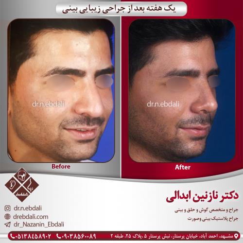 جراحی بینی