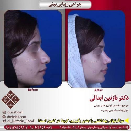 جراحی بینی 269 (10)
