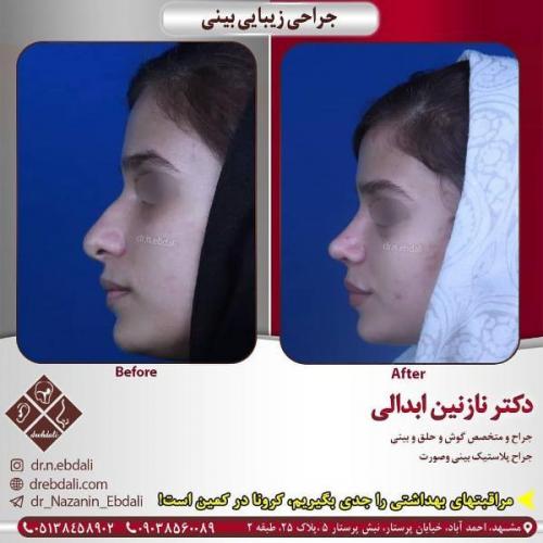 جراحی بینی 269 (11)