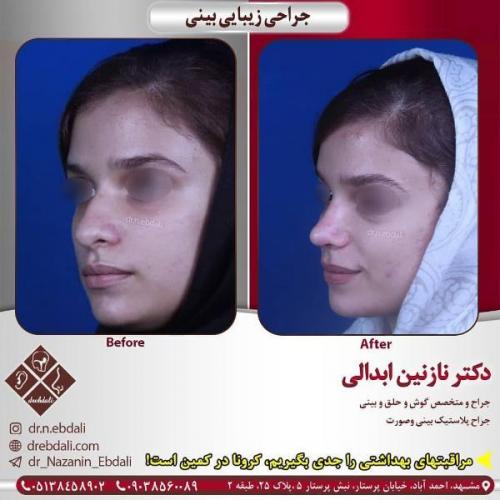 جراحی بینی 269 (12)