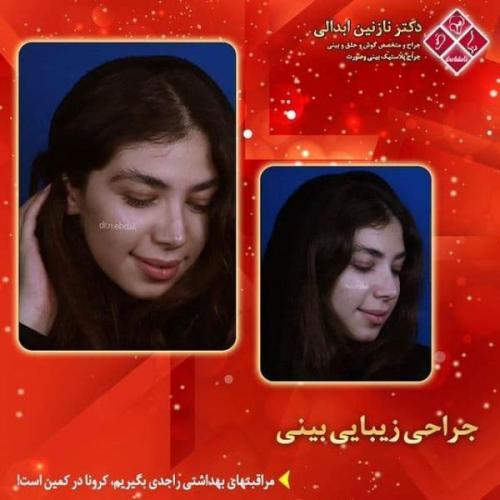 جراحی بینی 269 (13)