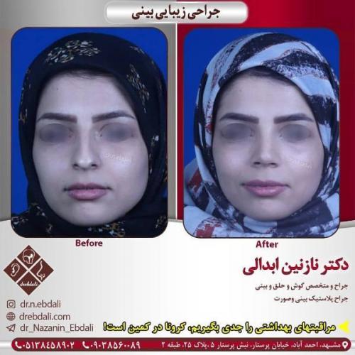 جراحی بینی 269 (14)