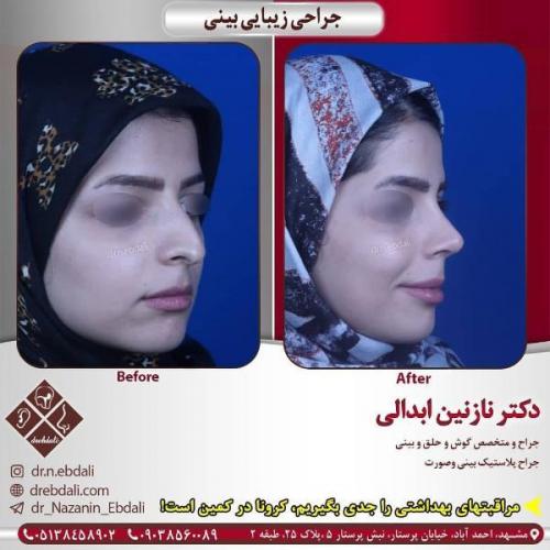 جراحی بینی 269 (15)