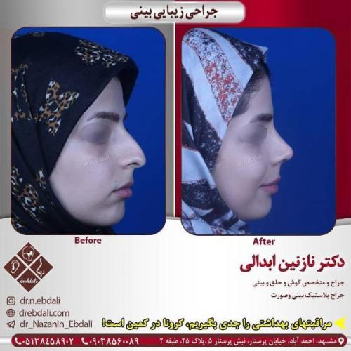 جراحی بینی 269 (16)