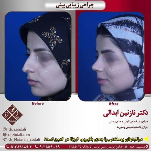 جراحی بینی 269 (17)