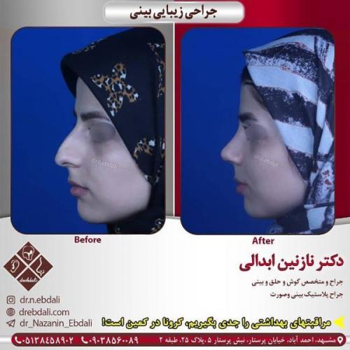 جراحی بینی 269 (18)