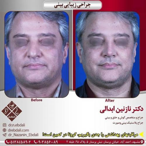 جراحی بینی 269 (2)