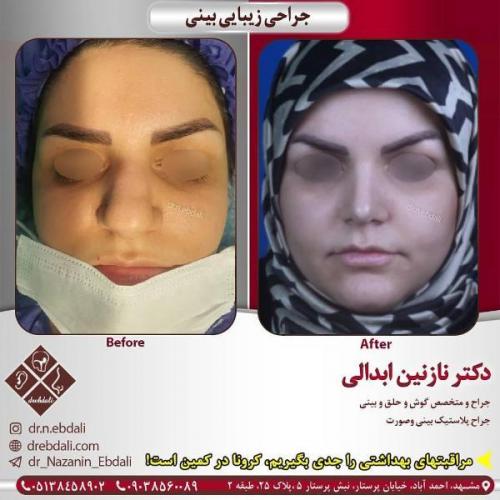 جراحی بینی 269 (20)