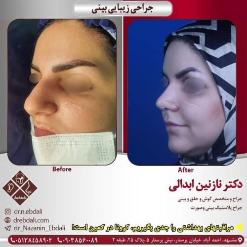 جراحی بینی 269 (21)