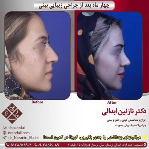 جراحی بینی 269 (23)