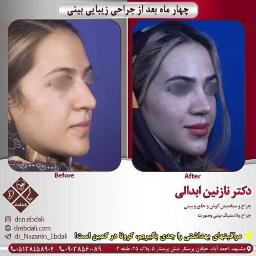جراحی بینی 269 (24)