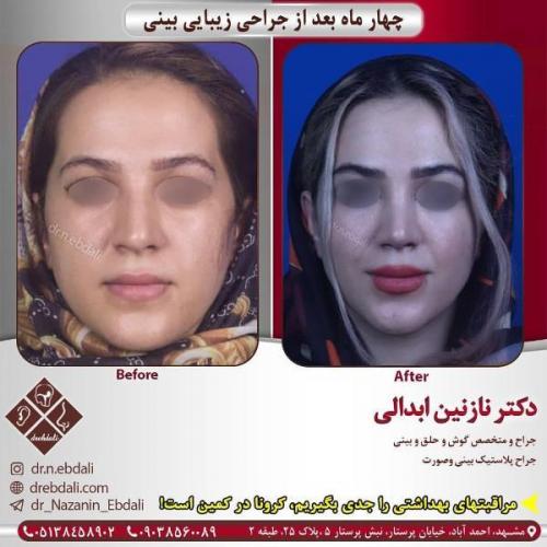 جراحی بینی 269 (25)
