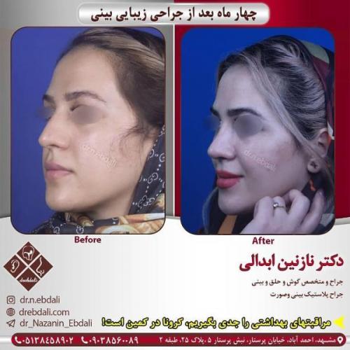 جراحی بینی 269 (26)