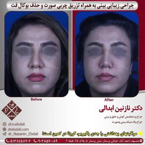 جراحی بینی 269 (28)