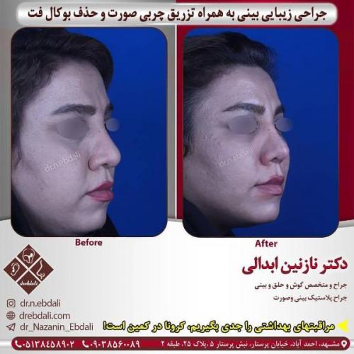 جراحی بینی 269 (29)
