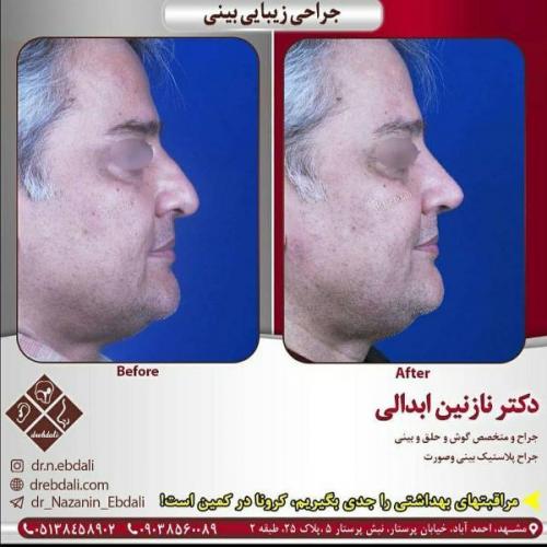 جراحی بینی 269 (3)