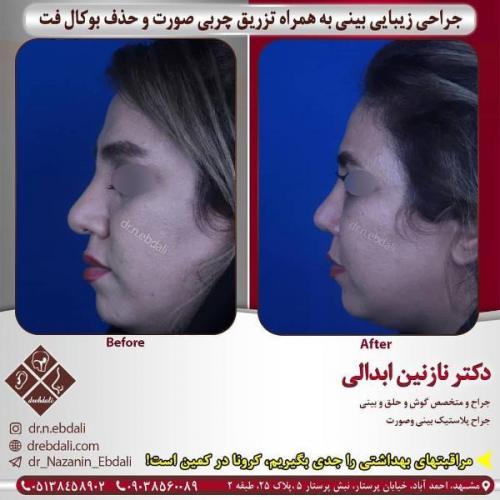 جراحی بینی 269 (30)