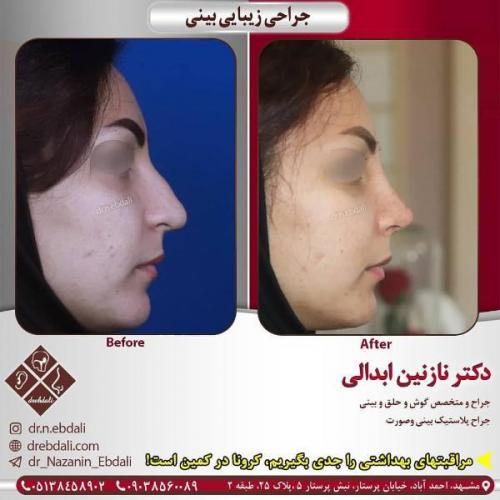 جراحی بینی 269 (32)