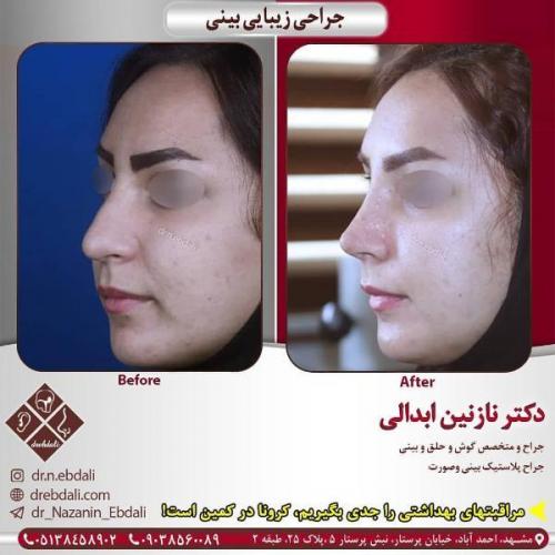 جراحی بینی 269 (33)
