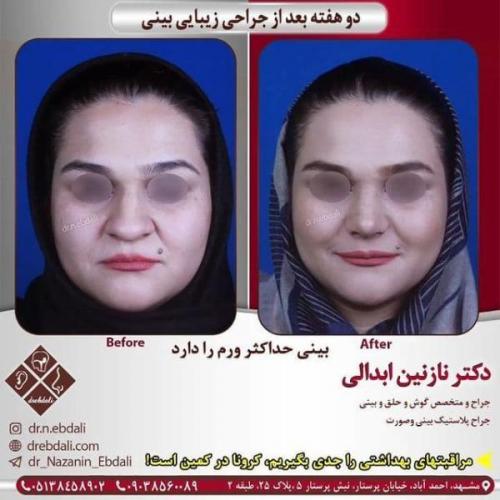 جراحی بینی 269 (35)