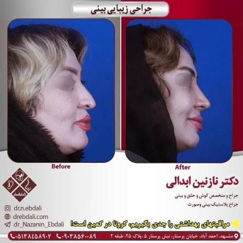 جراحی بینی 269 (38)