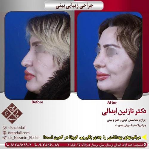 جراحی بینی 269 (39)