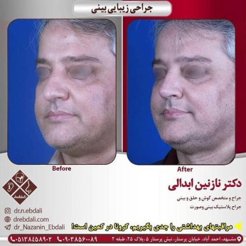 جراحی بینی 269 (4)