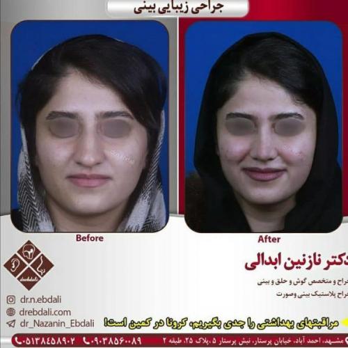 جراحی بینی 269 (42)