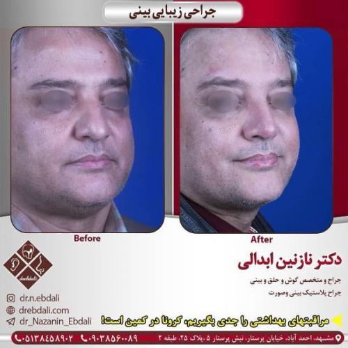 جراحی بینی 269 (5)
