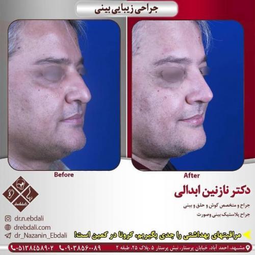 جراحی بینی 269 (6)