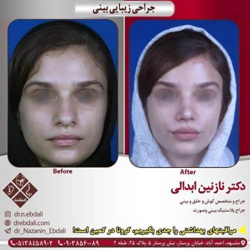 جراحی بینی 269 (8)