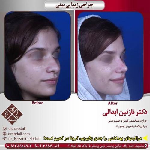جراحی بینی 269 (9)