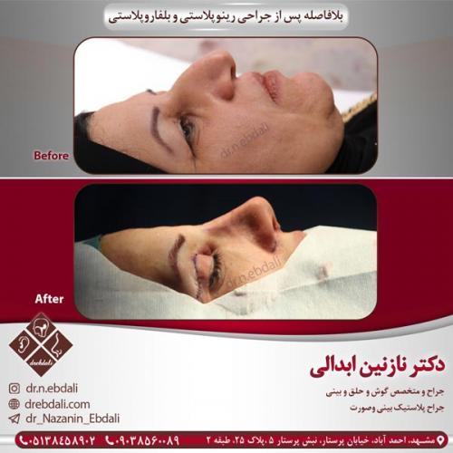 جراحی بینی