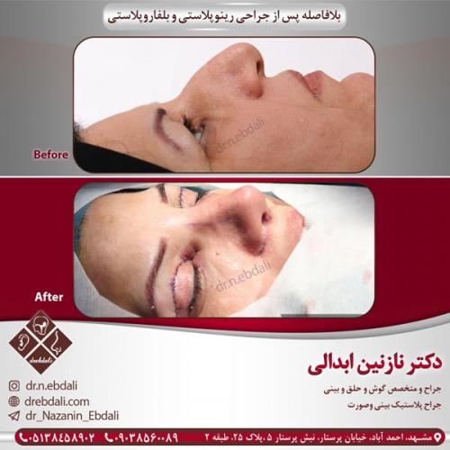 جراحی بینی