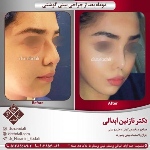 جراحی بینی