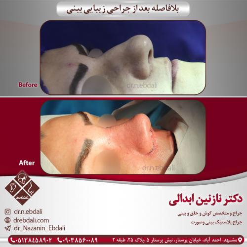 جراحی بینی