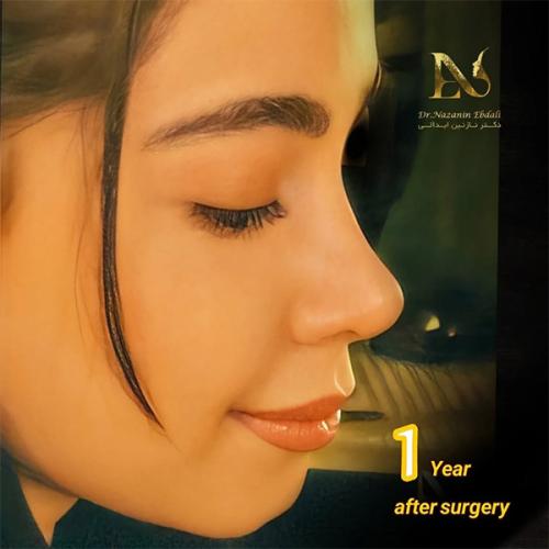 rhinoplasty-784