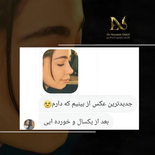 rhinoplasty-785
