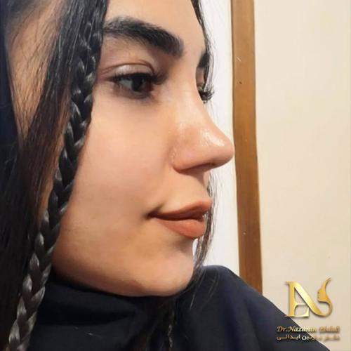rhinoplasty-786