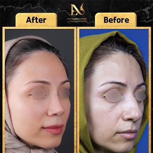 rhinoplasty-789