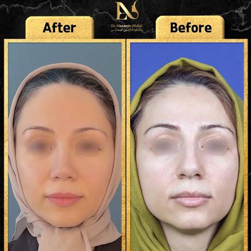 rhinoplasty-790