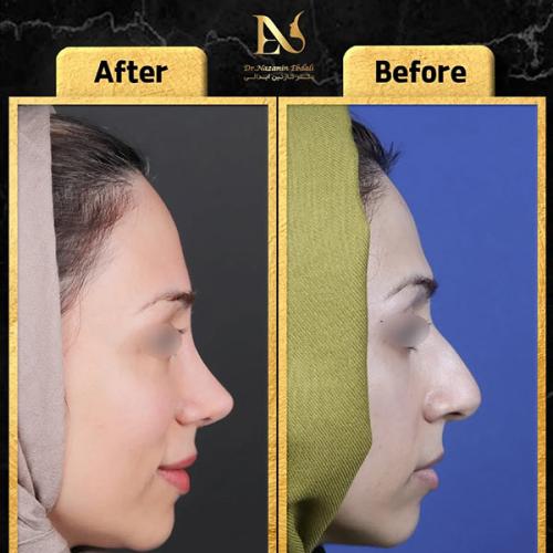 rhinoplasty-791