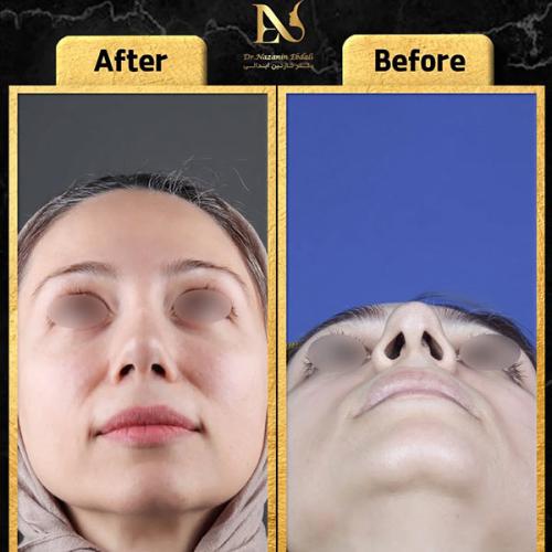 rhinoplasty-792