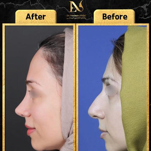 rhinoplasty-793
